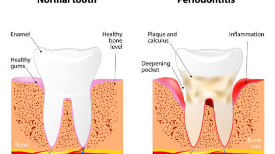 Will Gum Disease Put You at Greater Risk for Covid-19?, Bradenton dental