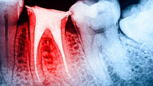 Bradenton Dentist Explains What a Root Canal Is – and Why You Shouldn’t Be Afraid If You Need One